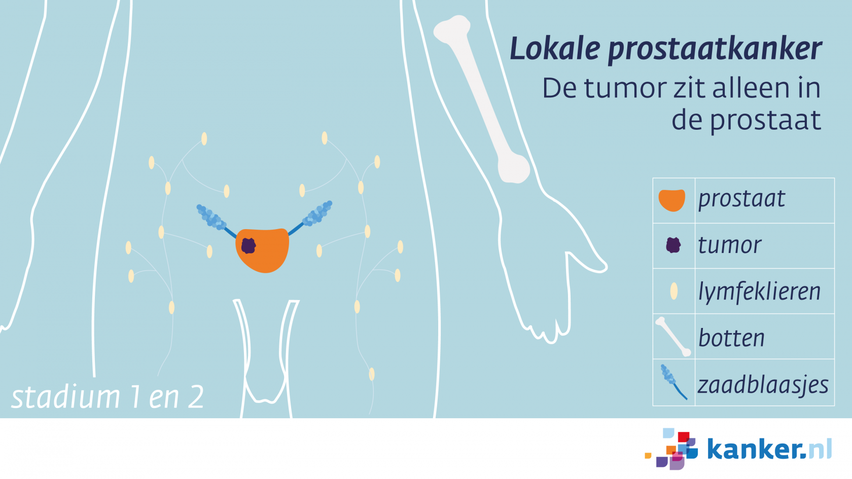 Het stadium van prostaatkanker | Kanker.nl